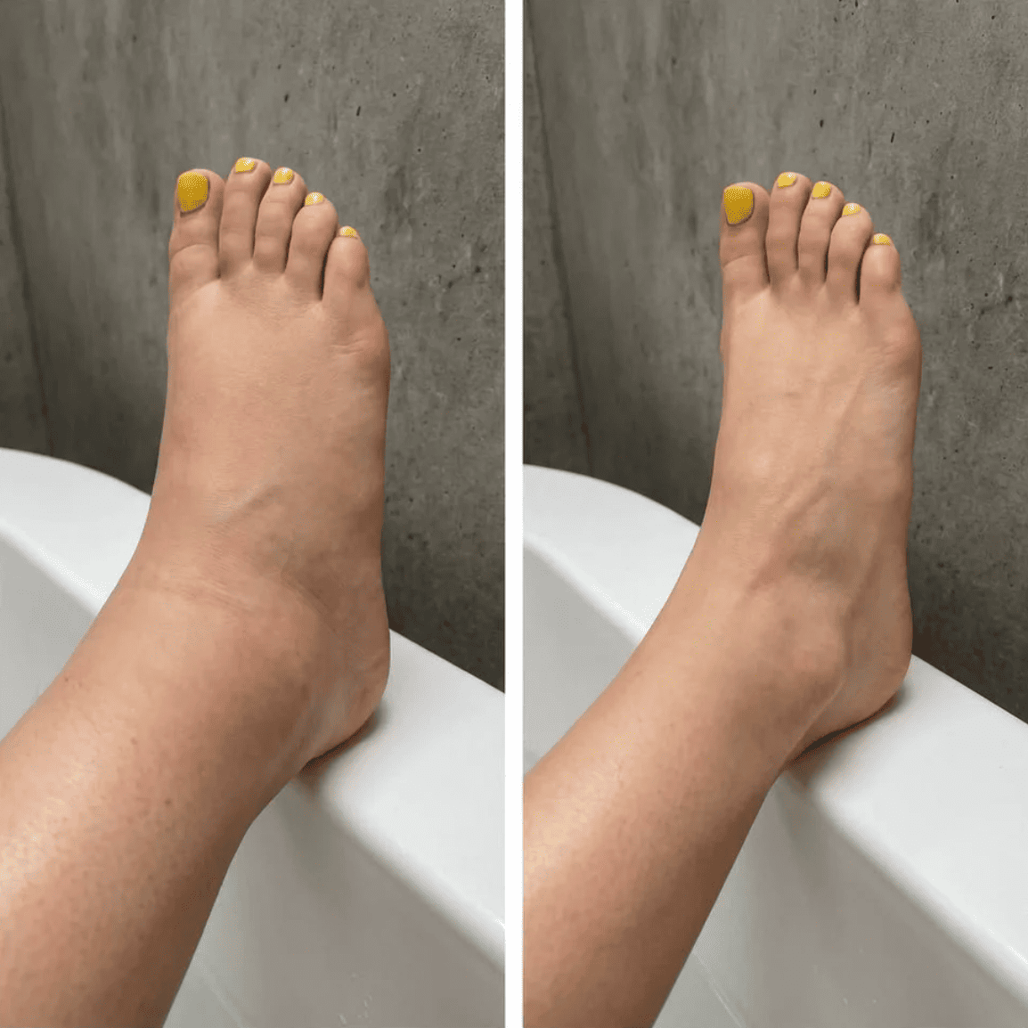 DRENAGGIO LINFATICO